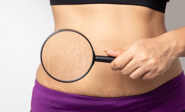 Stretch Marks home remedies